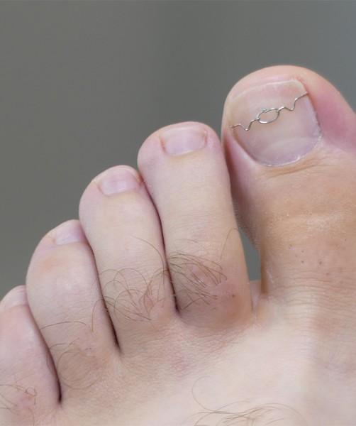 Orthonyxie ongle incarné