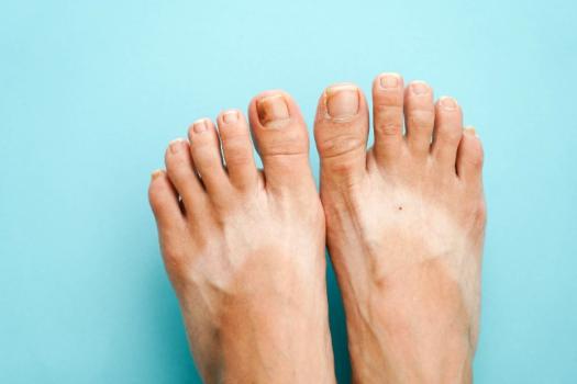 Ongle incarné