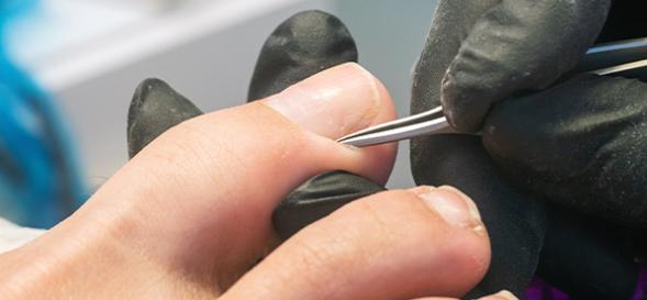 Podologie ongle incarné