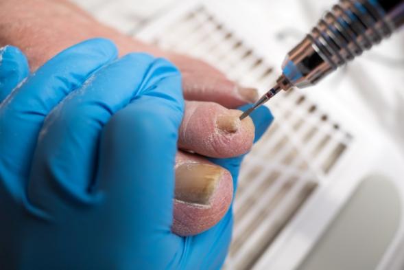Ongle incarné douloureux