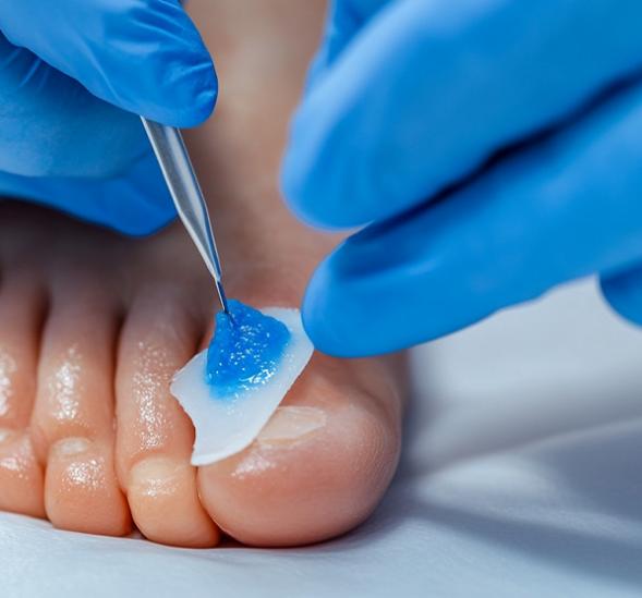 Onychoplastie ongle