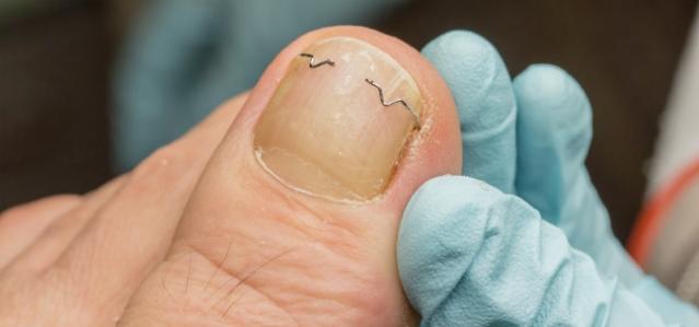 Ongle incarné
